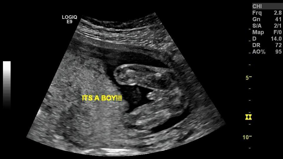 can an early dating scan be wrong