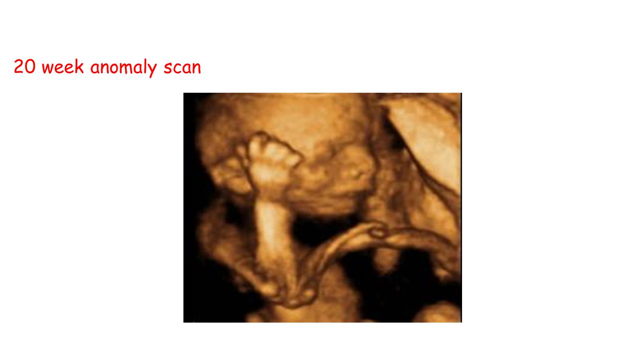 can ultrasound dating scan be wrong