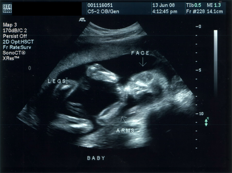 can a dating scan be wrong by 3 weeks