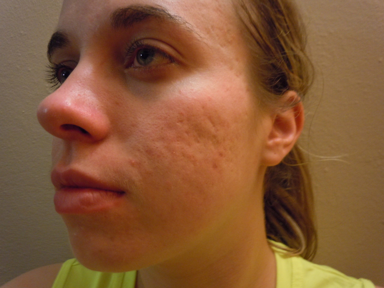dating with acne scars