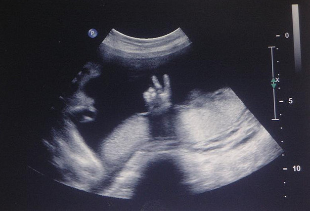 dating scan 6 weeks wrong